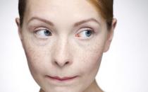 臉上出現雀斑給女性帶來困擾 養顏祛斑的食療方