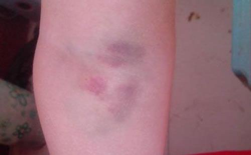 腿上莫名有淤青真是被鬼掐的嗎