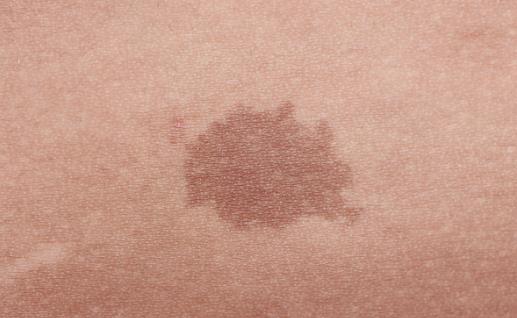 身上長(zhǎng)這種顏色胎記竟暗藏殺機(jī) 小心胎記可能是疾病信號(hào)