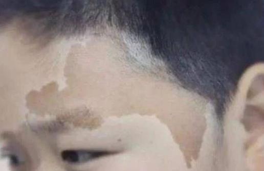 身上長(zhǎng)這種顏色胎記竟暗藏殺機(jī) 小心胎記可能是疾病信號(hào)