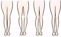 O型腿不是靠綁就能拉直的 大腿紋不對稱家長要留神