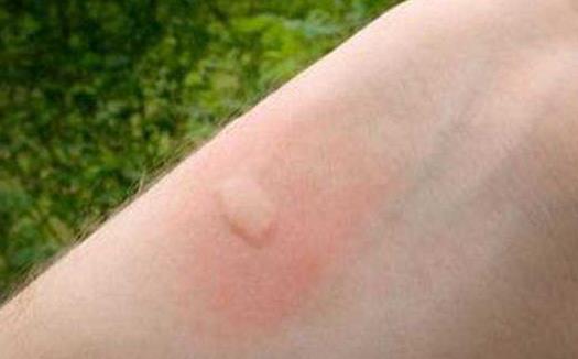 花露水不能驅蟑螂 花露水的主要作用