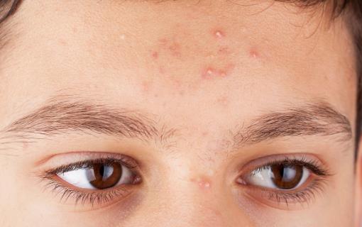 別在硬擠黑頭粉刺 教你即刻恢復干凈漂亮鼻頭