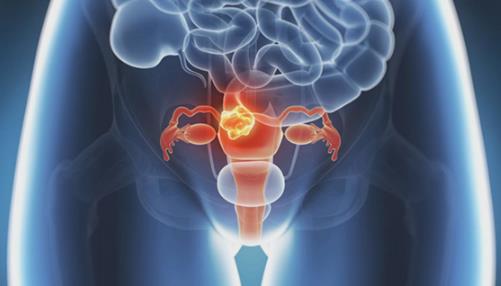 排尿困難或不暢竟是卵巢癌的信號 卵巢癌的飲食禁忌
