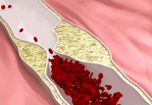 臉色發(fā)紅是不是血脂堵塞了血管？血脂過高的人會(huì)有什么表