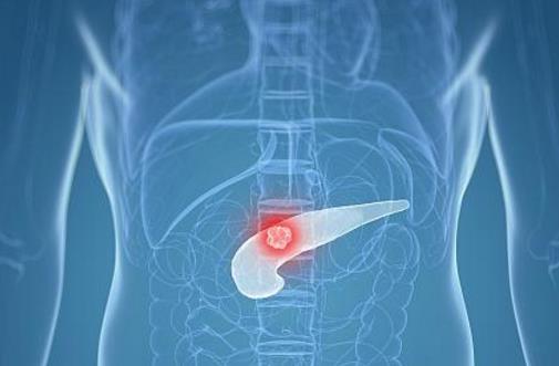 死亡率高達(dá)70%的胰腺炎,醫(yī)生提醒:有這3種現(xiàn)象的人尤為