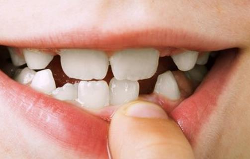 牙齦發炎腫痛怎么辦 養出健康口腔少不了六必治