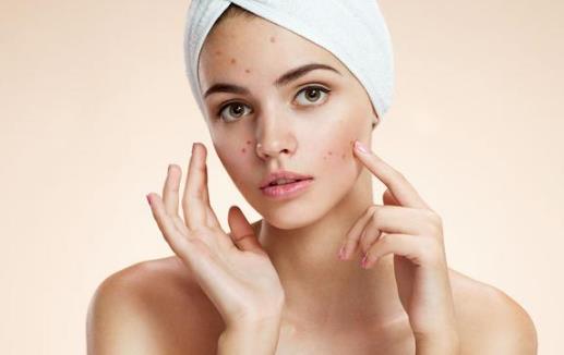 臉上反復長痘痘的6大原因