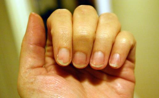 指甲上有豎紋是怎么回事？是好還是壞？聽聽專家怎么說