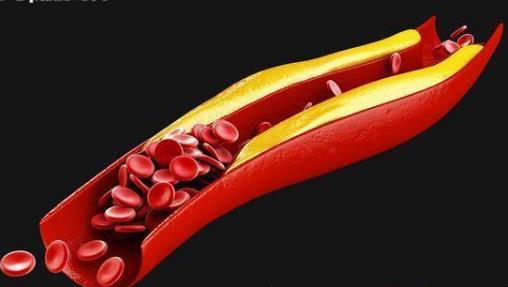 血脂總是上下波動？醫生：要注意這幾點，避免心腦血管出