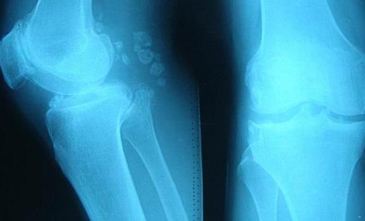 骨刺容易出現在這4個部位 骨刺患者不要隨便做按摩