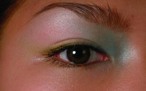 有的人割雙眼皮卻不好看 內眥贅皮使雙眼皮效果不好