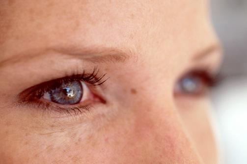 有的人割雙眼皮卻不好看 內眥贅皮使雙眼皮效果不好