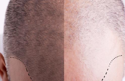 防止掉頭發(fā)除了食療還要做到這幾點(diǎn)