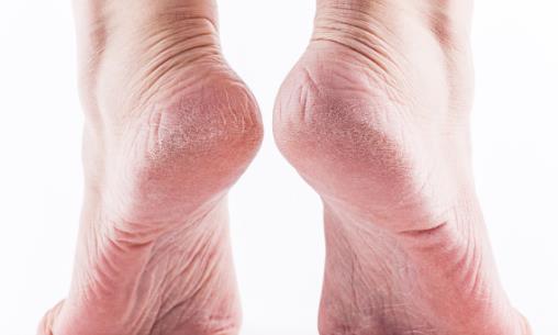 腳部干燥易脫皮 教你6步護(hù)腳