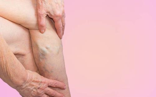 孕婦水腫怎么辦 多運(yùn)動多休息