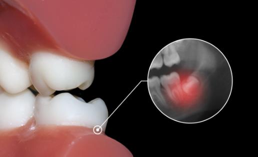 不良智齒應(yīng)及時拔掉 不需要拔智齒的三種情況