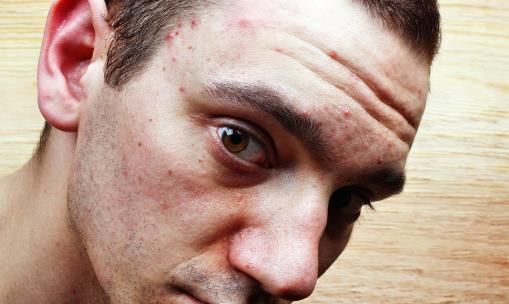 日常護膚避開去粉刺的護膚誤區 去粉刺的方法大全