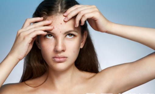 痘痘的調理不能盲目進行 10個民間快速有效祛痘小偏方 