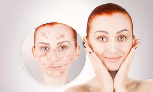 臉上反復長痘痘的6大原因