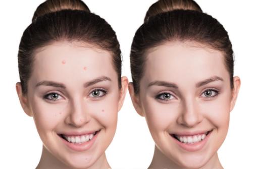 消除痘痘的洗臉法推薦