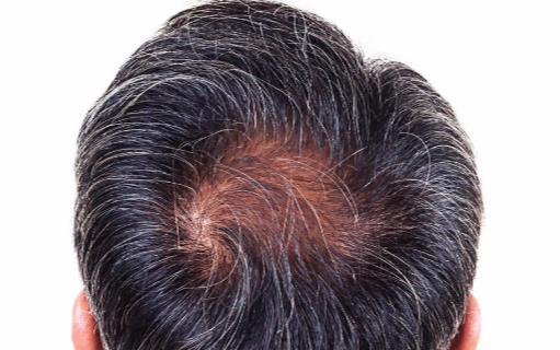 白發生長位置標志著臟腑健康 前額白發多為脾胃失調