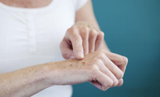 有效去除老年斑的方法小集錦