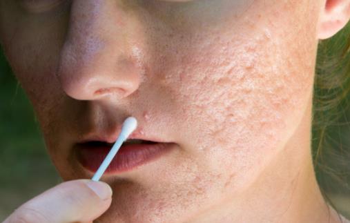 有效淡化疤痕的6個(gè)小妙招