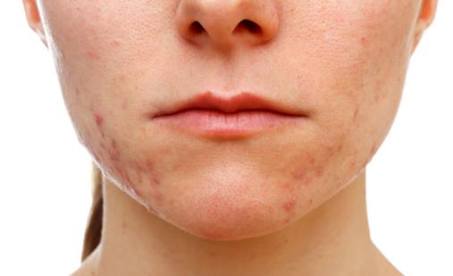 有效淡化疤痕的6個(gè)小妙招