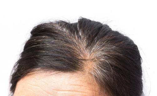 為什么有些人的頭發(fā)兩鬢會先白