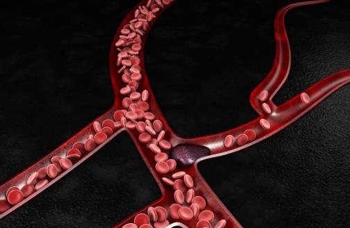 血栓是怎么形成的？如何遠離血栓？