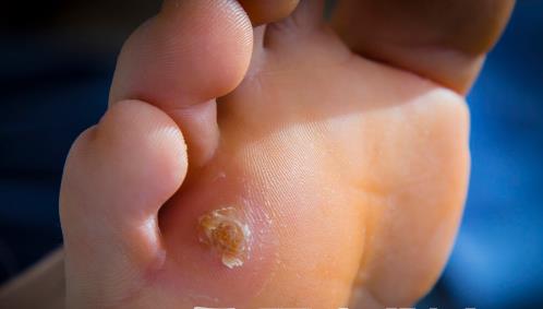 腳下出現老繭比較嚴重怎