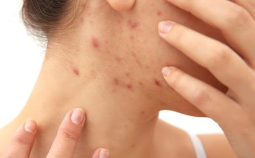 皮炎輕松解決方法