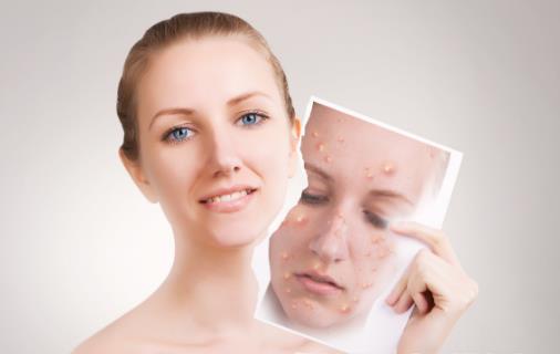 辣椒無辜背鍋！營養(yǎng)學專家說，長痘的“真兇”是這三種食