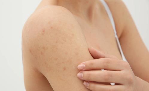 皮膚高度過敏怎么保濕 方法在這里