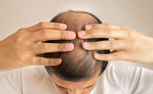 頭發(fā)少要怎么保養(yǎng)？四個(gè)問(wèn)題要注意