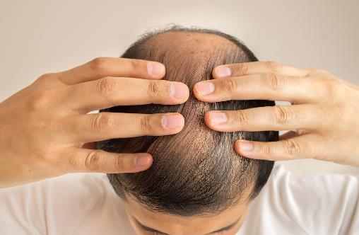 脫發(fā)厲害是身體出了問(wèn)題 怎樣才能長(zhǎng)出濃密秀發(fā)