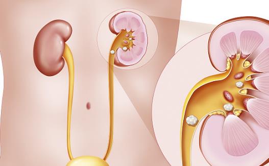 腎結石出現的六大原因 預防腎結石復發的飲食調理