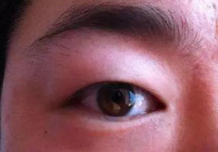 八大處整形楊欣：腫泡眼做雙眼皮手術應該注意什么？