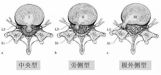 患上腰椎病,一定不能拖!內鏡微創手術,一步治好它!