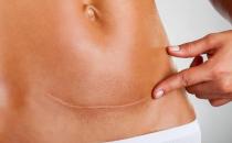 ?剖腹產的傷口該拿你怎么辦 如何防止剖腹產疤痕增生