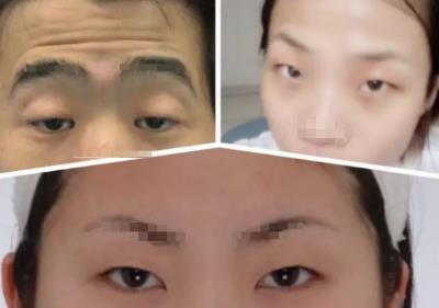 內眥贅皮怎么做效果好——北京彤美整形醫院劉風卓