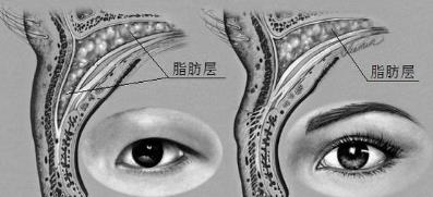 內眥贅皮怎么做效果好——北京彤美整形醫院劉風卓