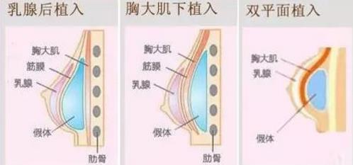 北京韓嘯醫生：為什么假體隆胸手術之后胸部疼痛