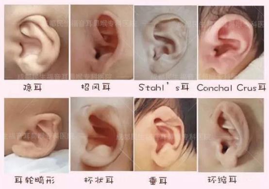 新生兒耳廓畸形能矯正嗎？看成都民生耳鼻喉醫(yī)院如何支招