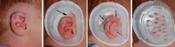 新生兒耳廓畸形能矯正嗎？看成都民生耳鼻喉醫(yī)院如何支招