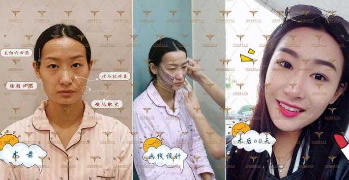 自體多肽脂肪實現新突破，塑造無法復制的自然美