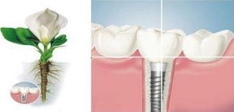 武漢做種植牙要多少錢，如何才能避免種植牙誤區呢？