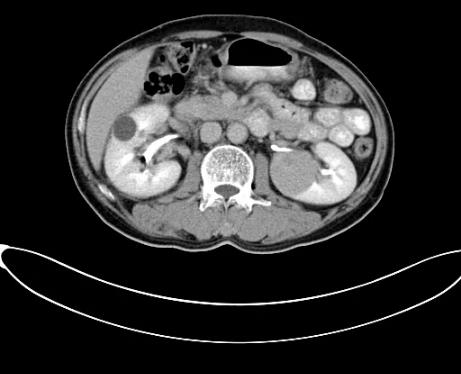 蘇州腫瘤醫院認準廣州復大醫院：有效治療雙腎腎癌