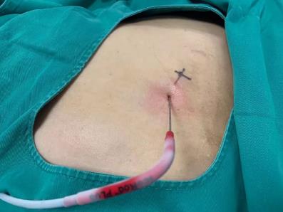 蘇州腫瘤醫院認準廣州復大醫院：有效治療雙腎腎癌